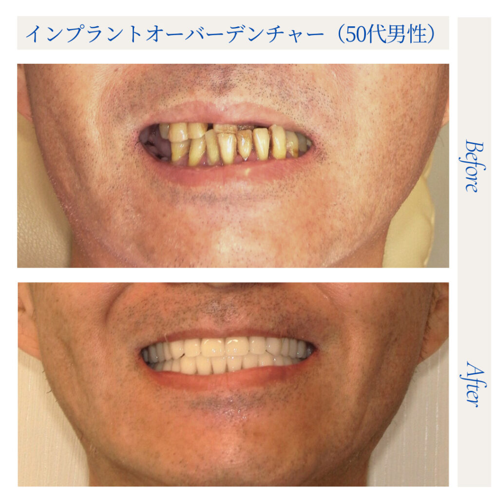 インプラントオーバーデンチャー（IOD）／50代男性_01