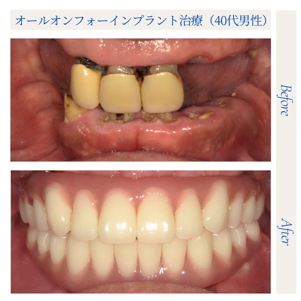 オールオンフォー（All-on-4）インプラント治療_40代男性_02