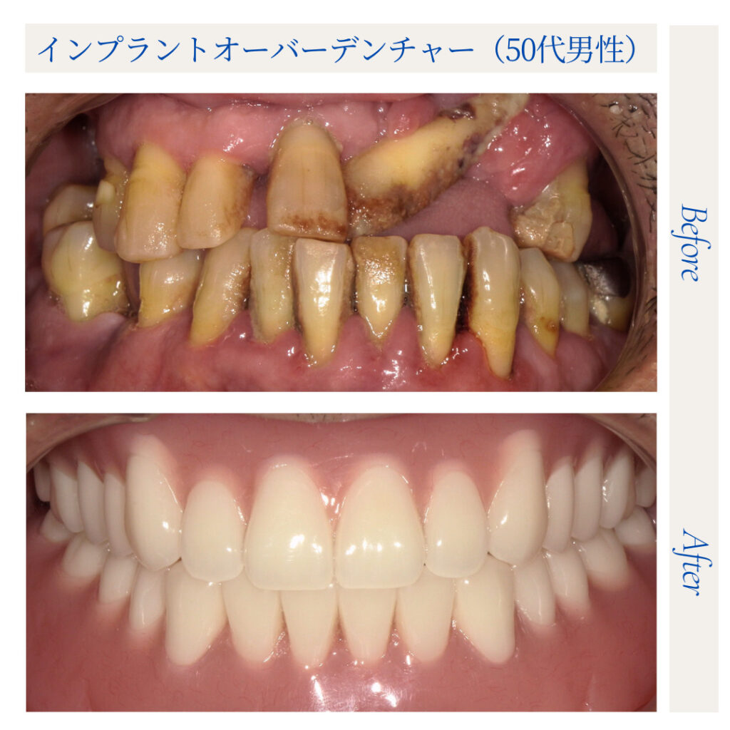 インプラントオーバーデンチャー（IOD）／50代男性_02