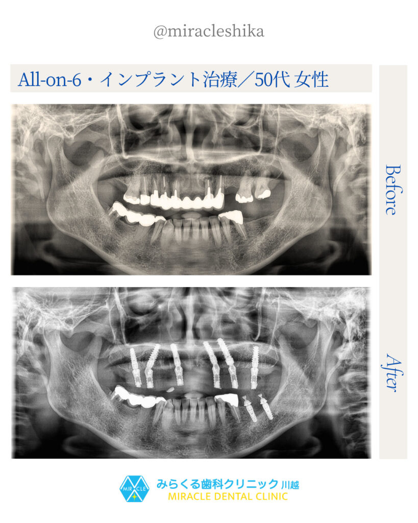 All-on-6・インプラント治療／50代 女性