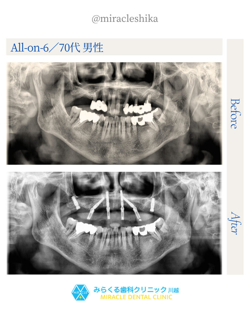 All-on-6/70代 男性
