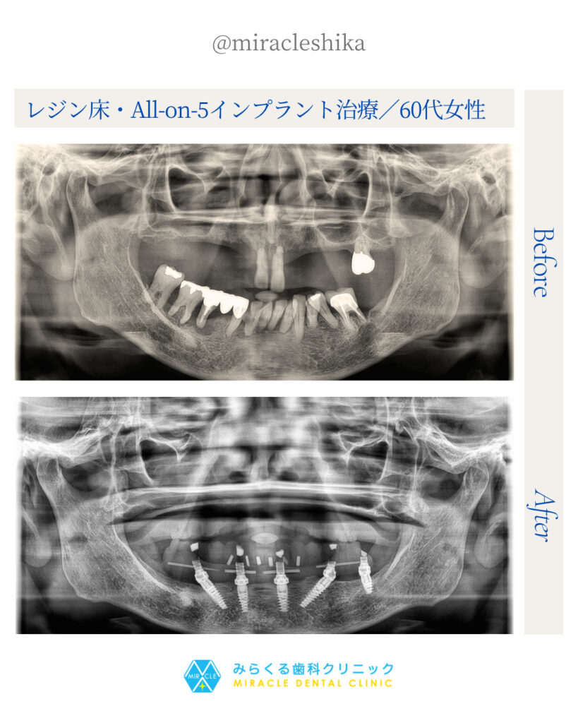 レジン床・All-on-5インプラント治療／60代女性