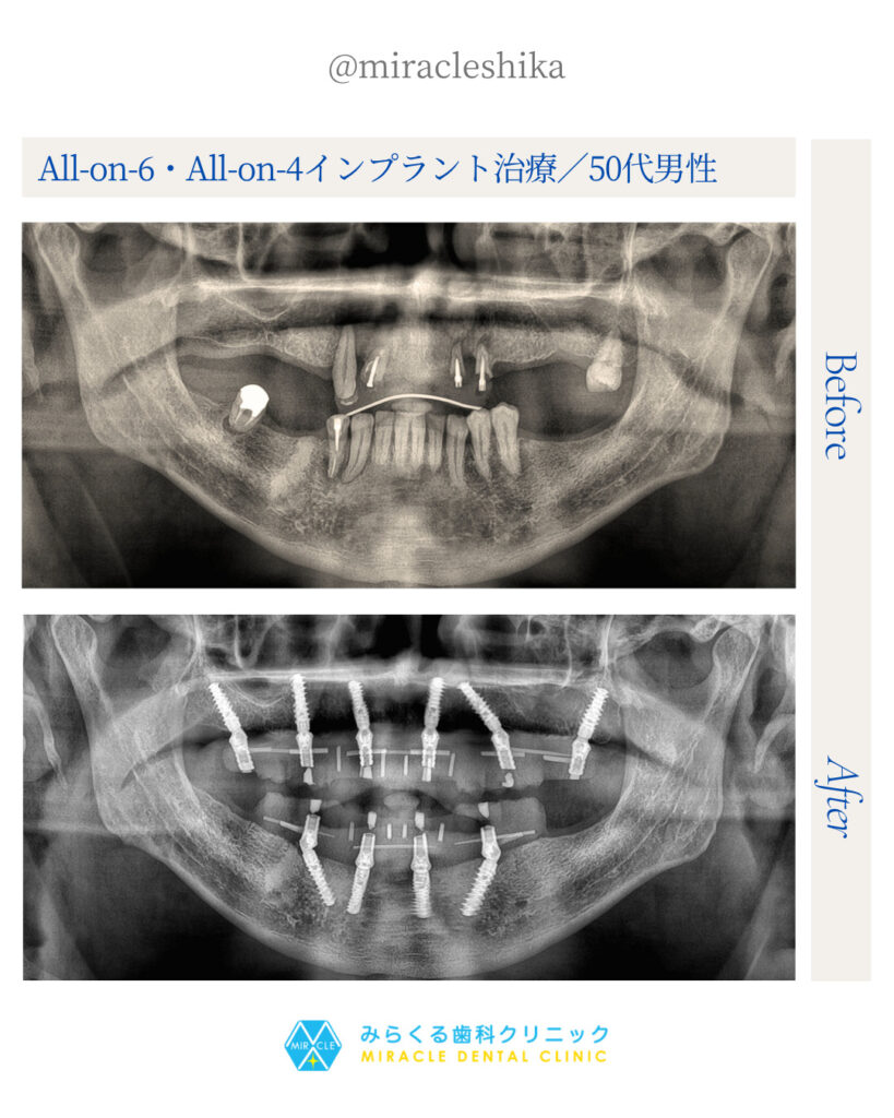 All-on-6・All-on-4インプラント治療/50代男性