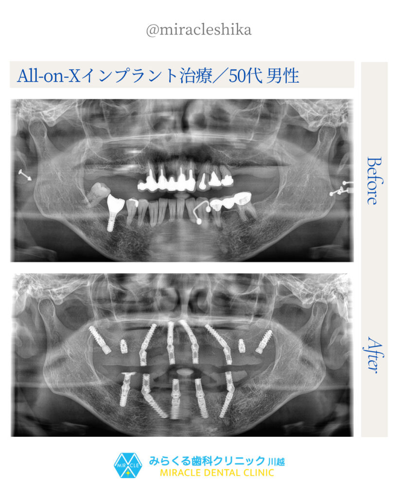 All-on-Xインプラント治療／50代 男性