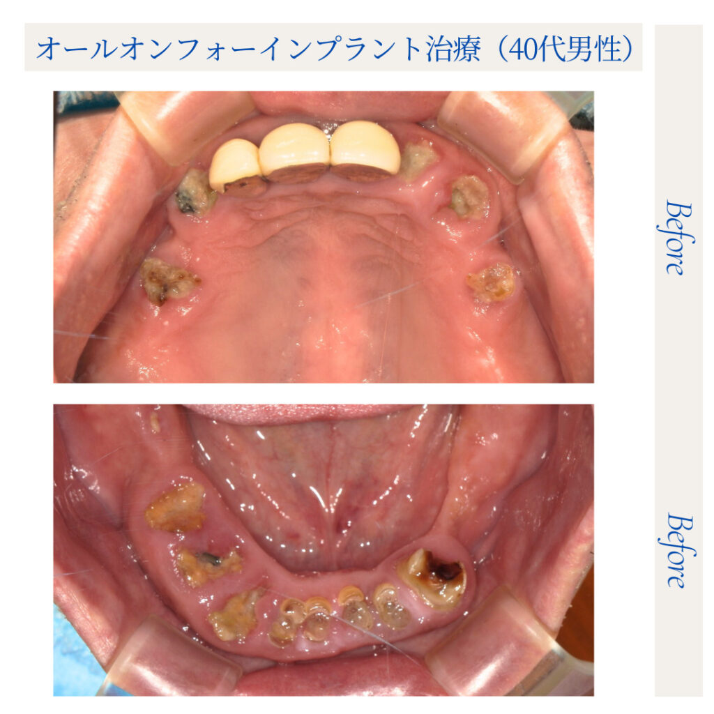 オールオンフォー（All-on-4）インプラント治療_40代男性_03