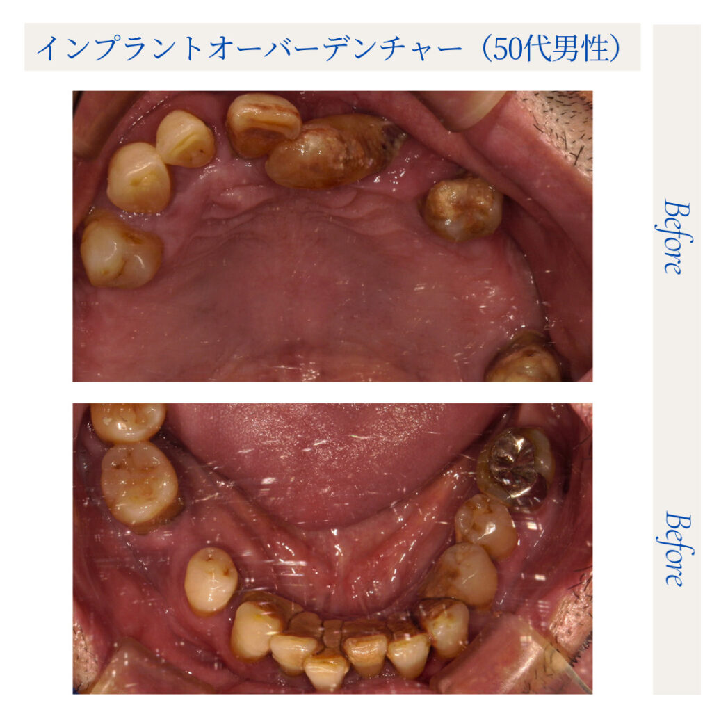 インプラントオーバーデンチャー（IOD）／50代男性_03