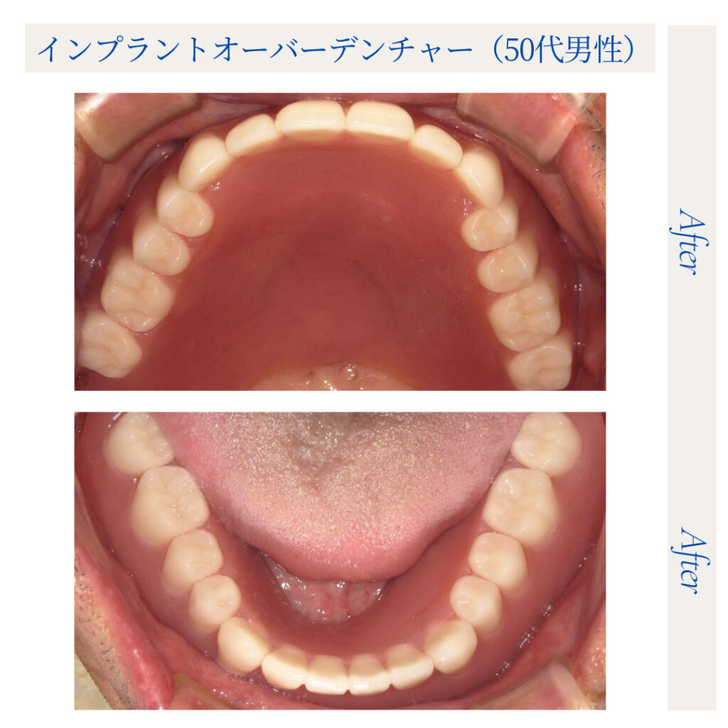 インプラントオーバーデンチャー（IOD）／50代男性_04