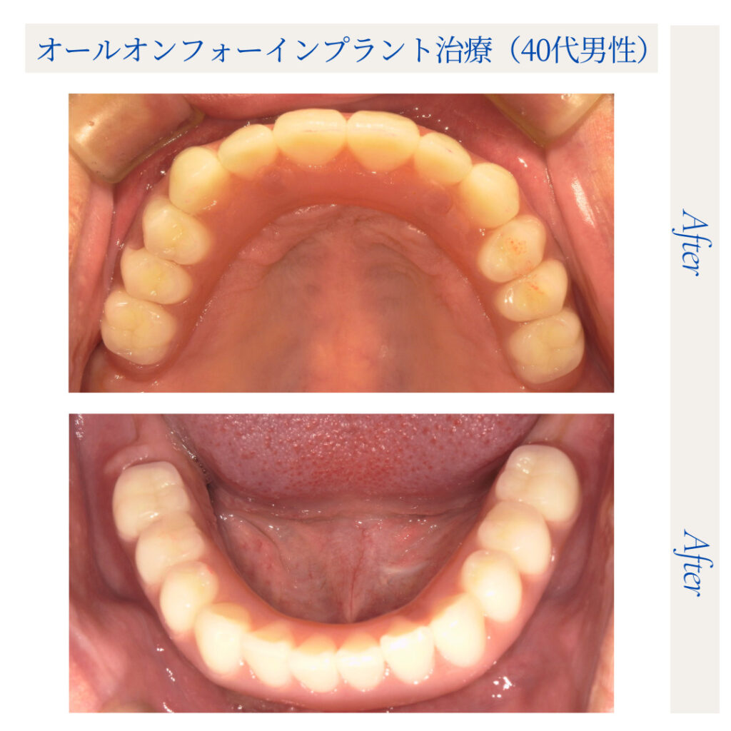 オールオンフォー（All-on-4）インプラント治療_40代男性_04